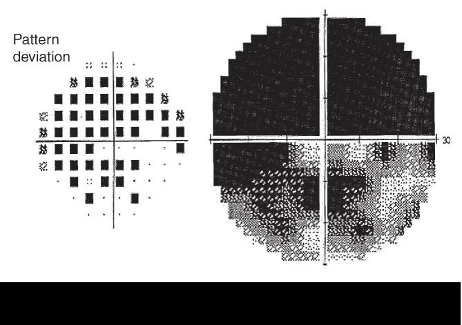 Visual field testing in advanced glaucoma