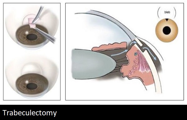 band trabeculectomy.jpg