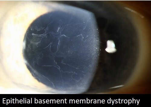 epithelial basement membrane dystrophy.jpg