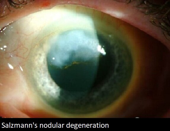 salzmann nodular degeneration.jpg