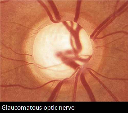 glaucoma_opticnerve.png