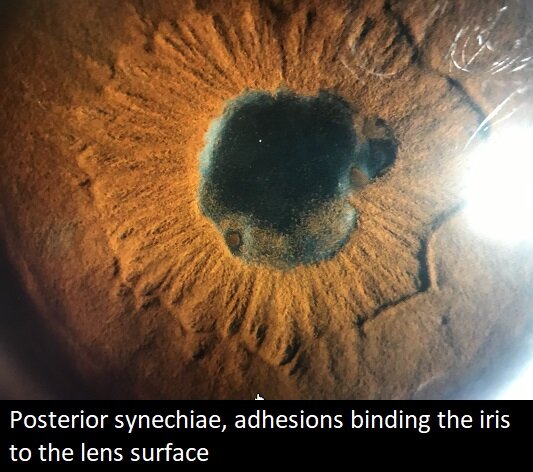 posterior-synechia-secondary-to-HLA-B27-anterior-uveitis.jpg