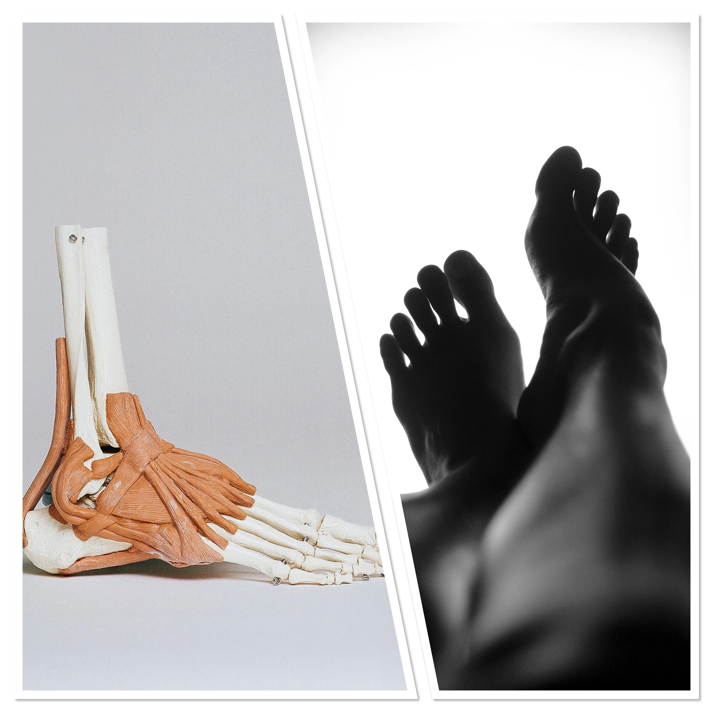 Plantar Fasciitis