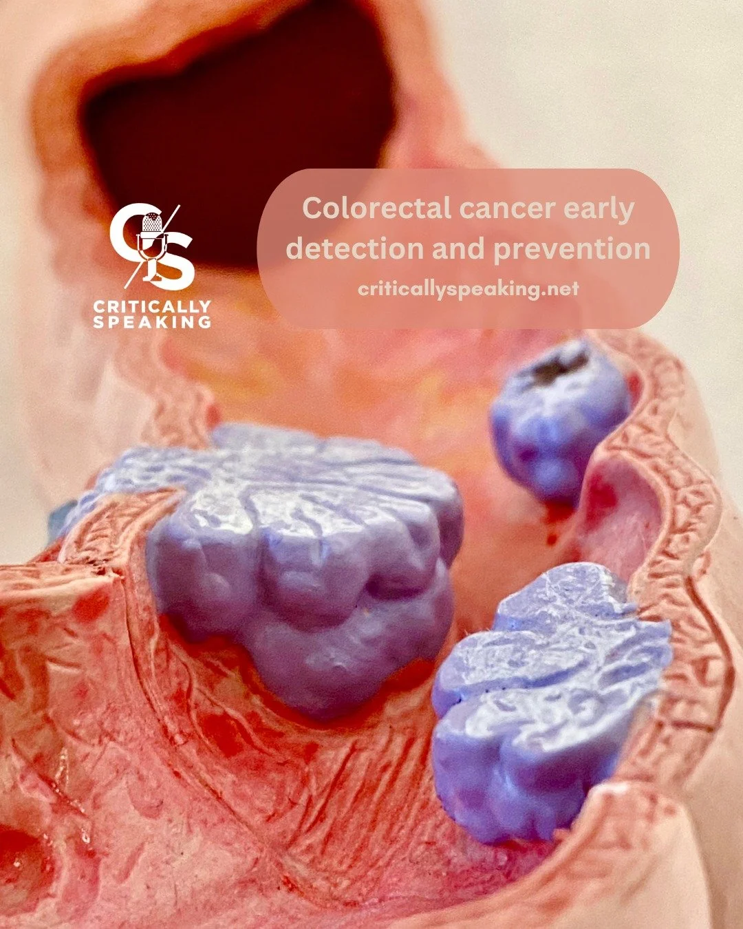 Ever wonder why screening for colorectal cancer is vital? Dr. Peter Llang explains the importance of early detection and prevention on this week's Critically Speaking podcast with Dr. Therese Markow.  Listen to the podcast at the link in bio. 

#canc