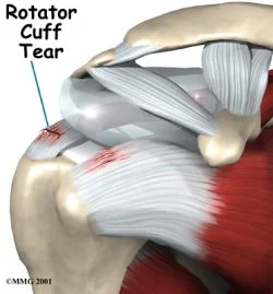 Rotator cuff tear?  See a PT first!