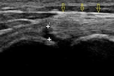 This is an ultrasound image of Shelby's tear. The yellow arrows show healthy biceps tendon, and the tear can be seen as the black line between the two "+" symbols.