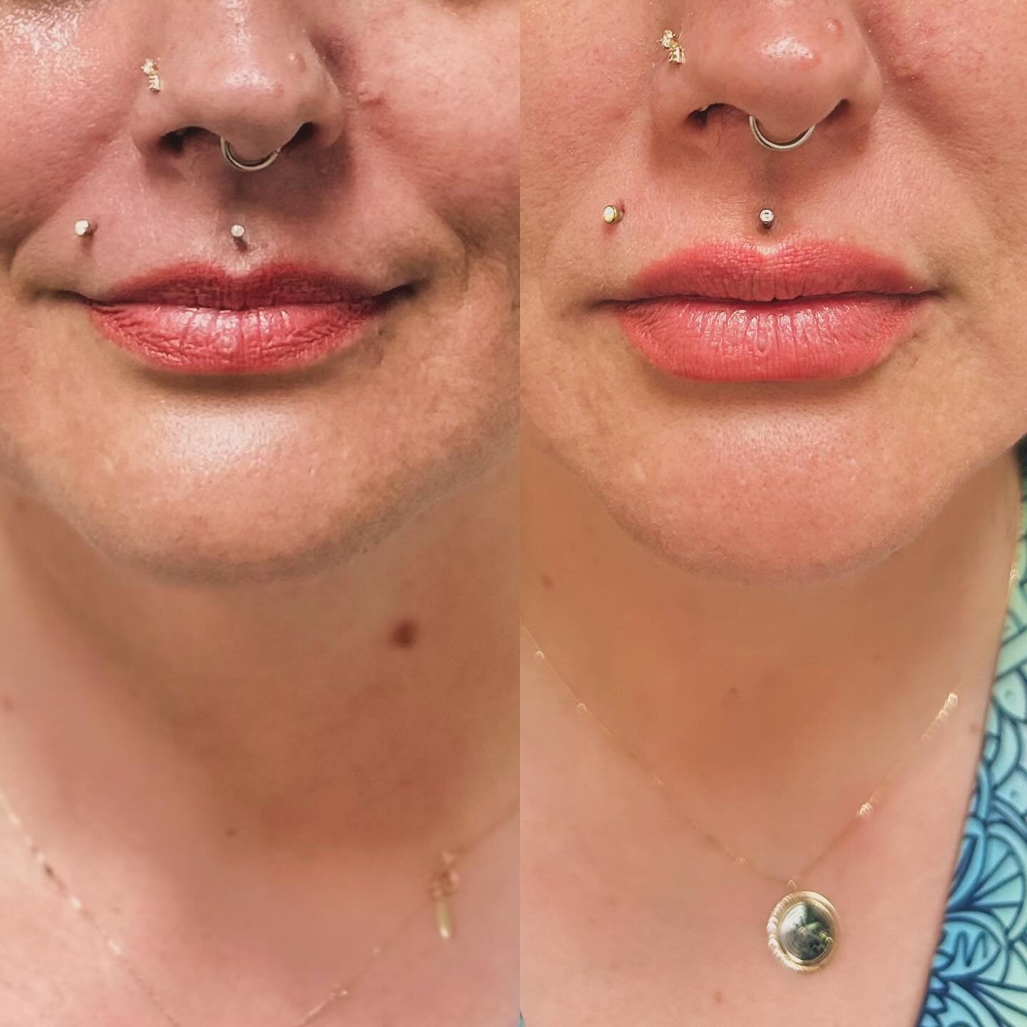 Before and After 1.0mL of Juvederm Vollure.  This client had lovely shaped lips before but wanted some volume and definition around the borders.  Her lips now frame her face so well and still look natural.  She is thrilled and so are we.  Don&rsquo;t