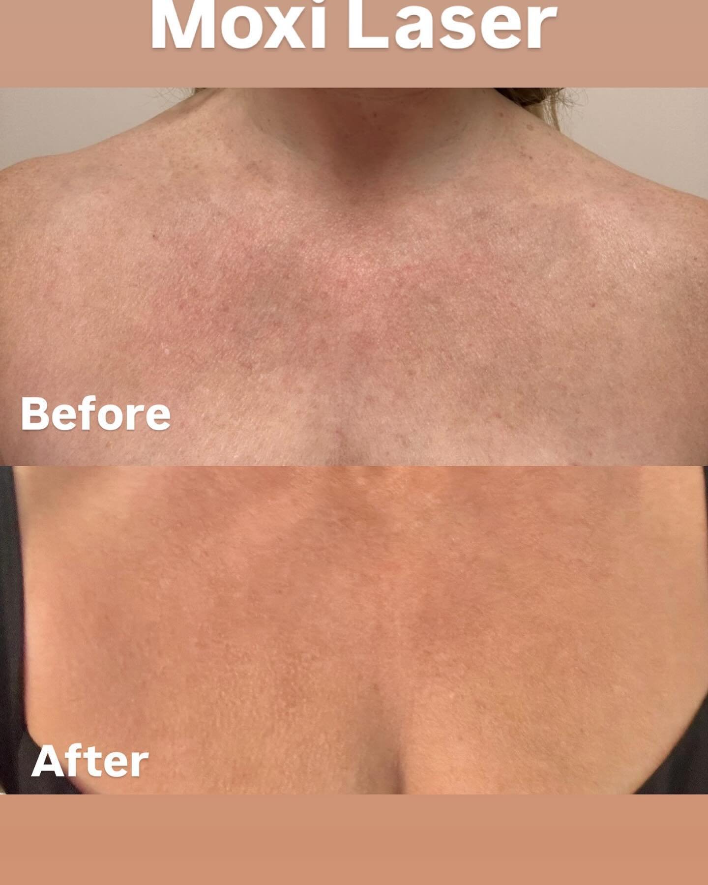 D&eacute;colletage Before and After Moxi laser treatment.  Skin tone is more even and smoother.  Pigment from redness and sun damage is improved.  Skin looks more youthful!  Moxi is a non-ablative laser that rejuvenates skin with minimal downtime.  C