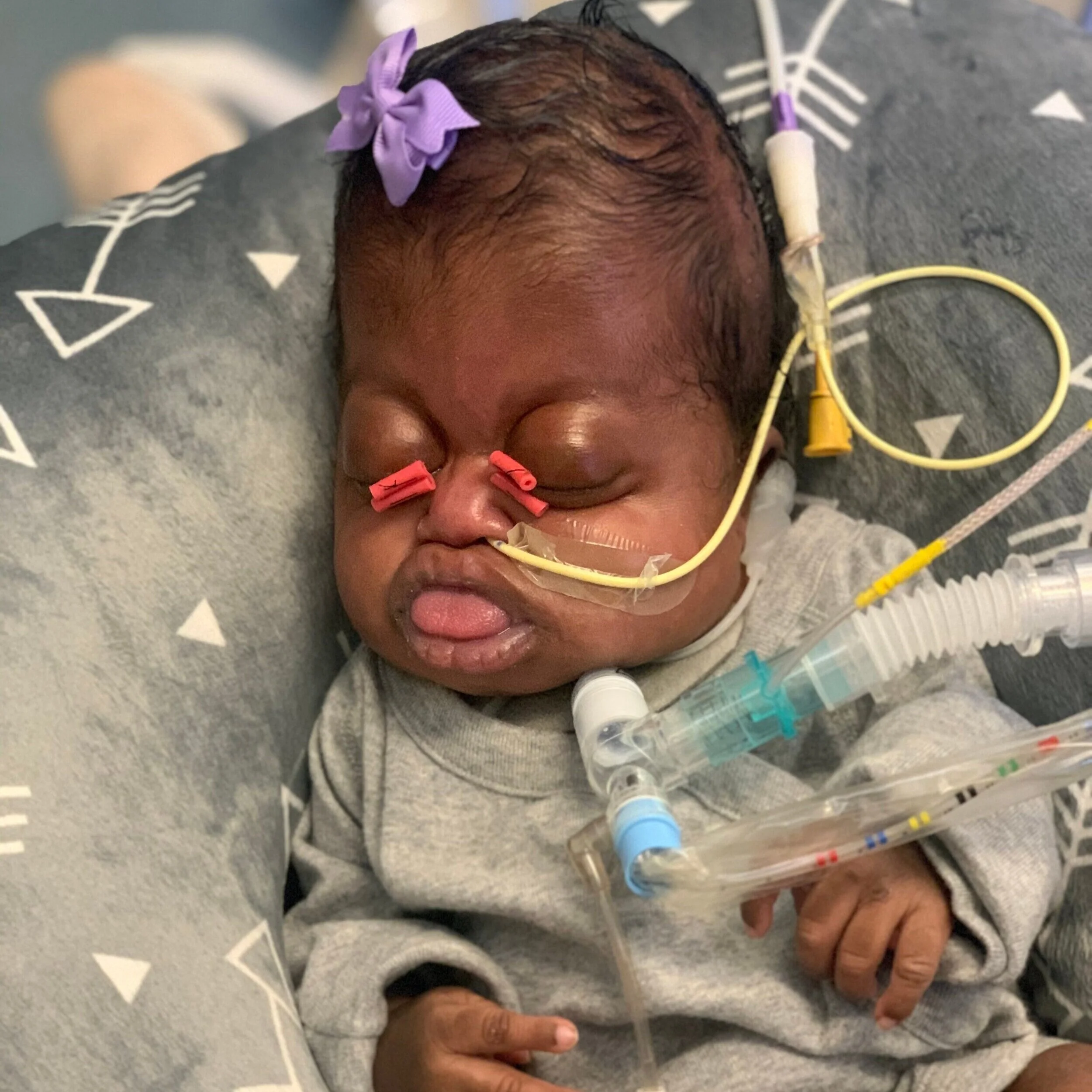 Pfeiffer Syndrome Part II- Treatment