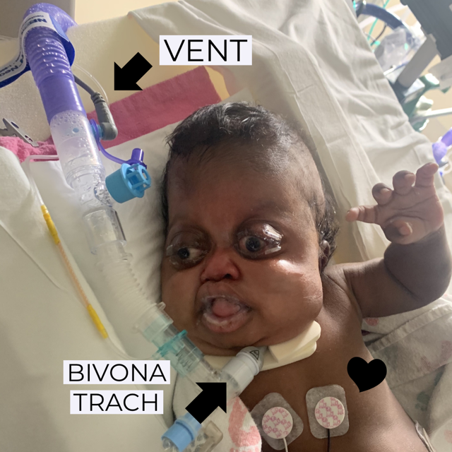 Pfeiffer Syndrome Part IV- Tracheostomy