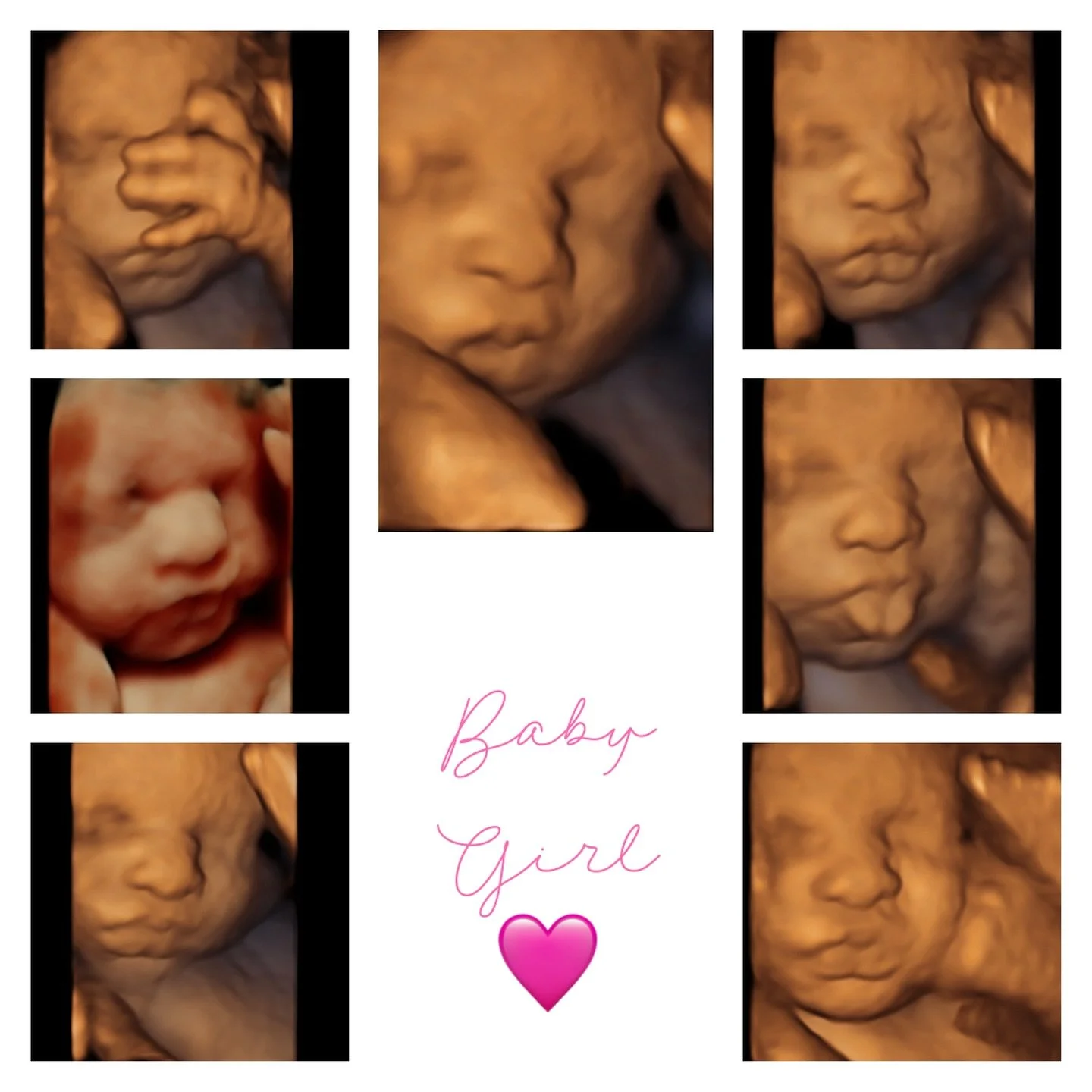 This little cutie making all the funny faces for us! 😝

#firstglimpsebr #ultrasound #3dultrasound #4dultrasound #sonogram #hdultrasound