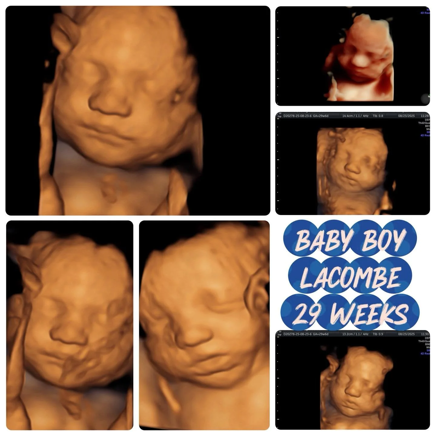 Those sweet little lips and chubby cheeks already have our hearts! 💙 Baby Boy Lacombe showed off his adorable face at 29 weeks, and we can&rsquo;t wait to meet him! Congratulations, Mom &amp; Dad! 🩵

#ultrasound #Congratulations #firstglimpsebr #pr