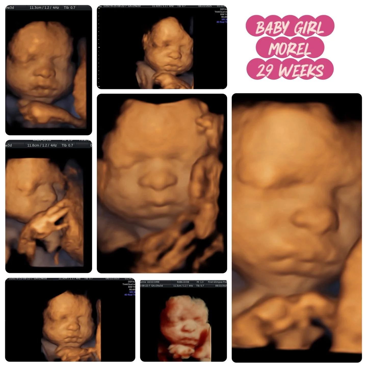 Can we all take a moment for those chubby cheeks?! 😍💗
Baby Girl Morel | 29 Weeks
We love getting to watch these little personalities shine before they&rsquo;re even born! Congratulations, Mom &amp; Dad! 🩷

#ultrasound #sonogram #firstglimpsebr  #t