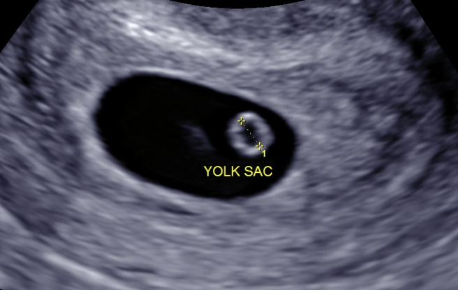 Early Pregnancy Ultrasounds — First Glimpse Prenatal Imaging
