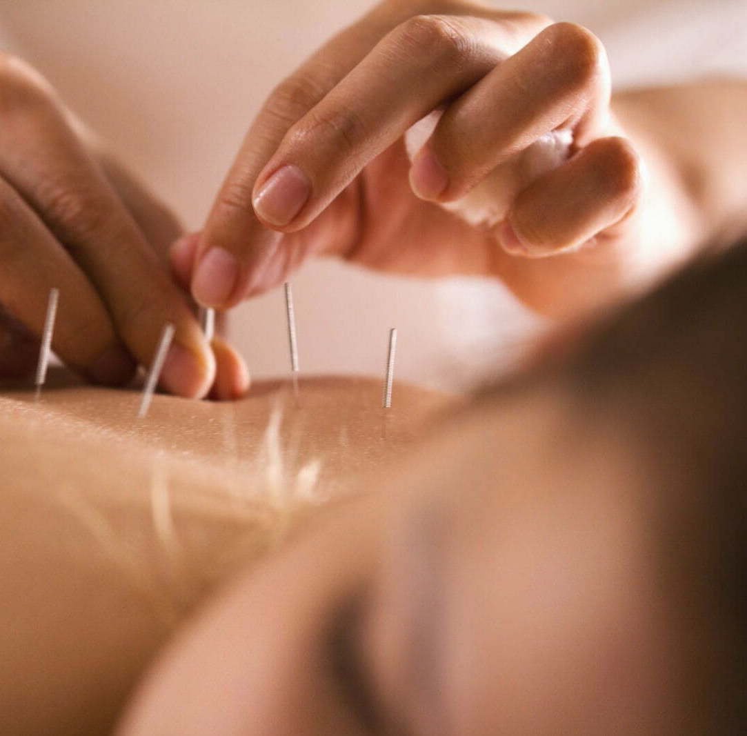 Acupuncture-nelson-bc.jpg