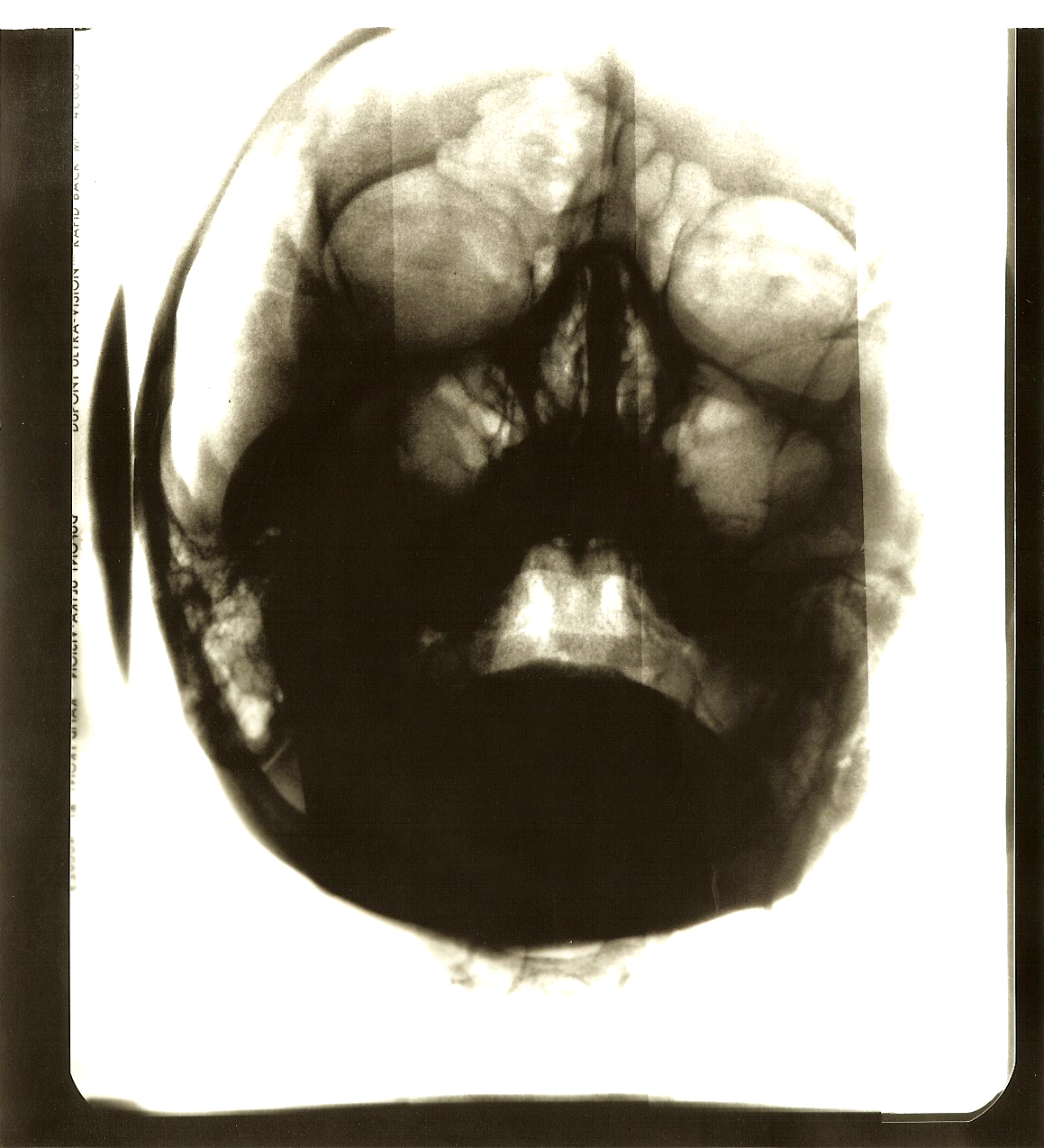 Self Portrait V, M.E (Myalgic Encephalomyelitis)