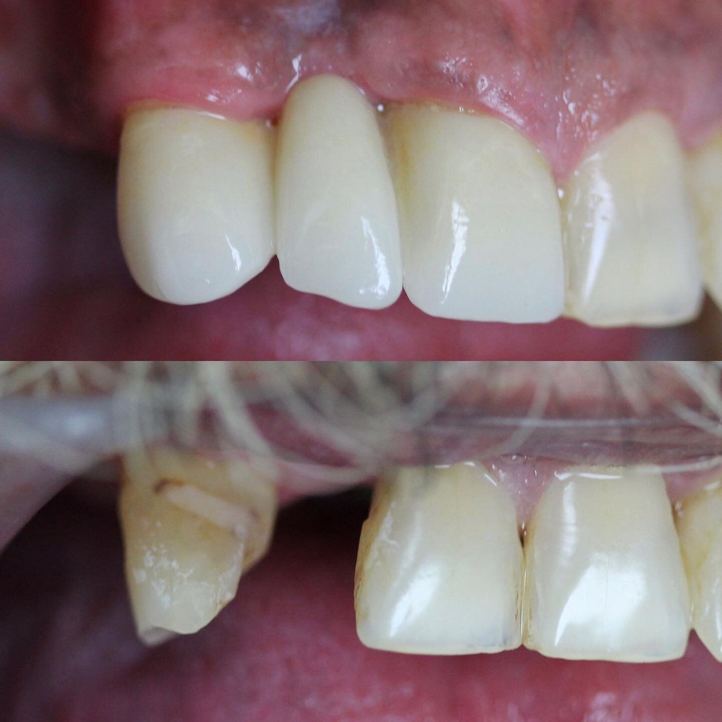 The journey for a full mouth rehab sometimes starts with just replacing one missing tooth. Three unit bridge to replace one missing front tooth