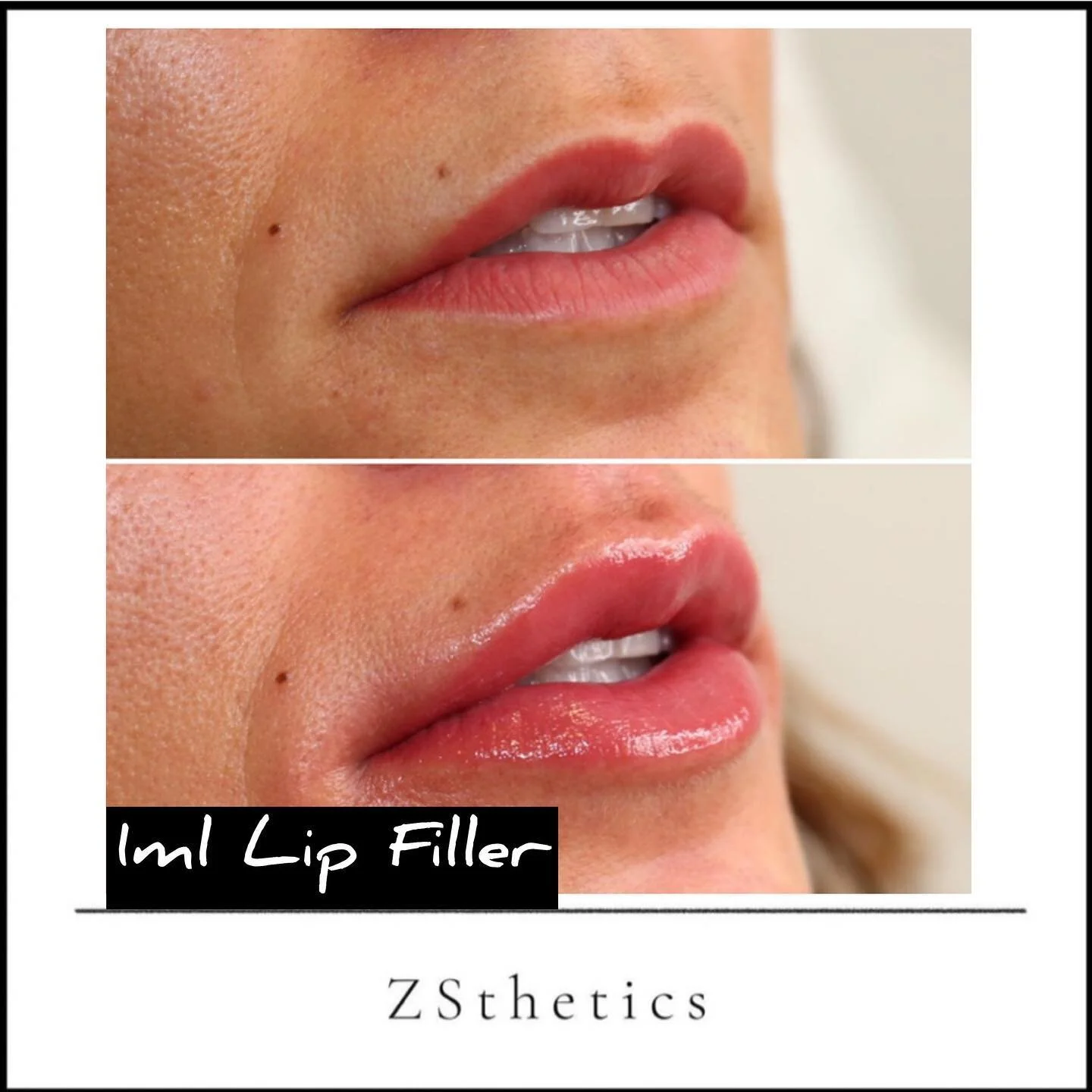 Beautiful results from Dr Zsaki, giving sophisticated and natural results using our famous signature cannula technique.
Gorgeous looking lips and less down time.

To book in one of our clinics:
 -Isleworth 
 -Chigwell @naked.lounge 
 -West Sussex @th