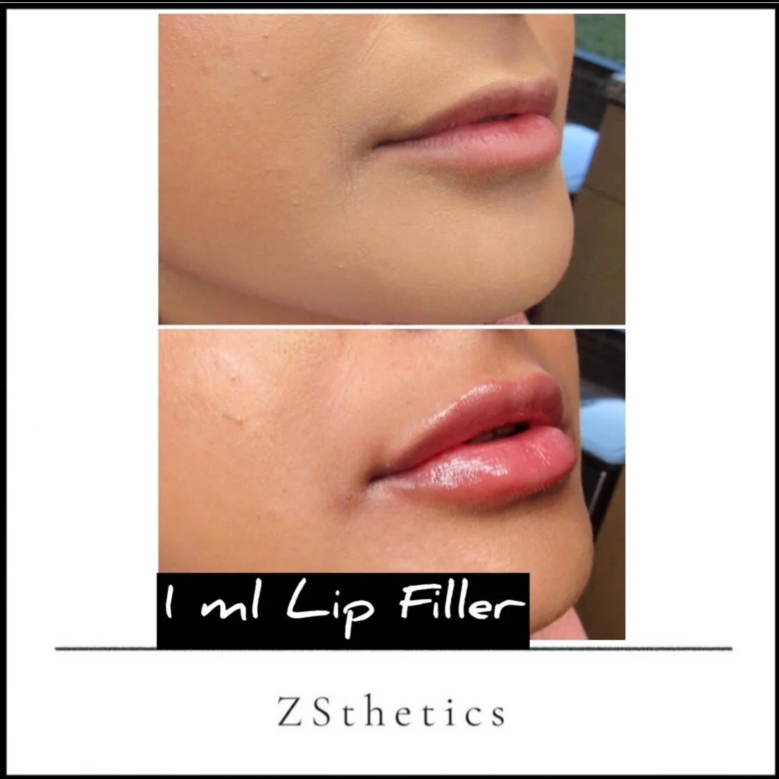 A little more plump, a little more hydration and a little more juicy. 
You don&rsquo;t need to over think it. Keeping it simple and natural is always the best way.

To book in to one of our clinics:
 -Isleworth 
 -Chigwell @naked.lounge 
 -West Susse