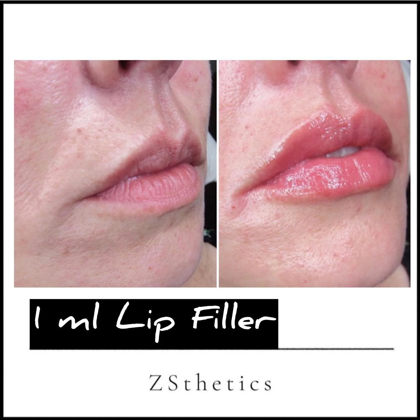 Not everyone wants the super glam fullness in their lips, in our experience, the more mature lady rarely wants that, instead she is more concerned with the shape, the vitality and overall &lsquo;condition&rsquo; of the lips. This is a great example o