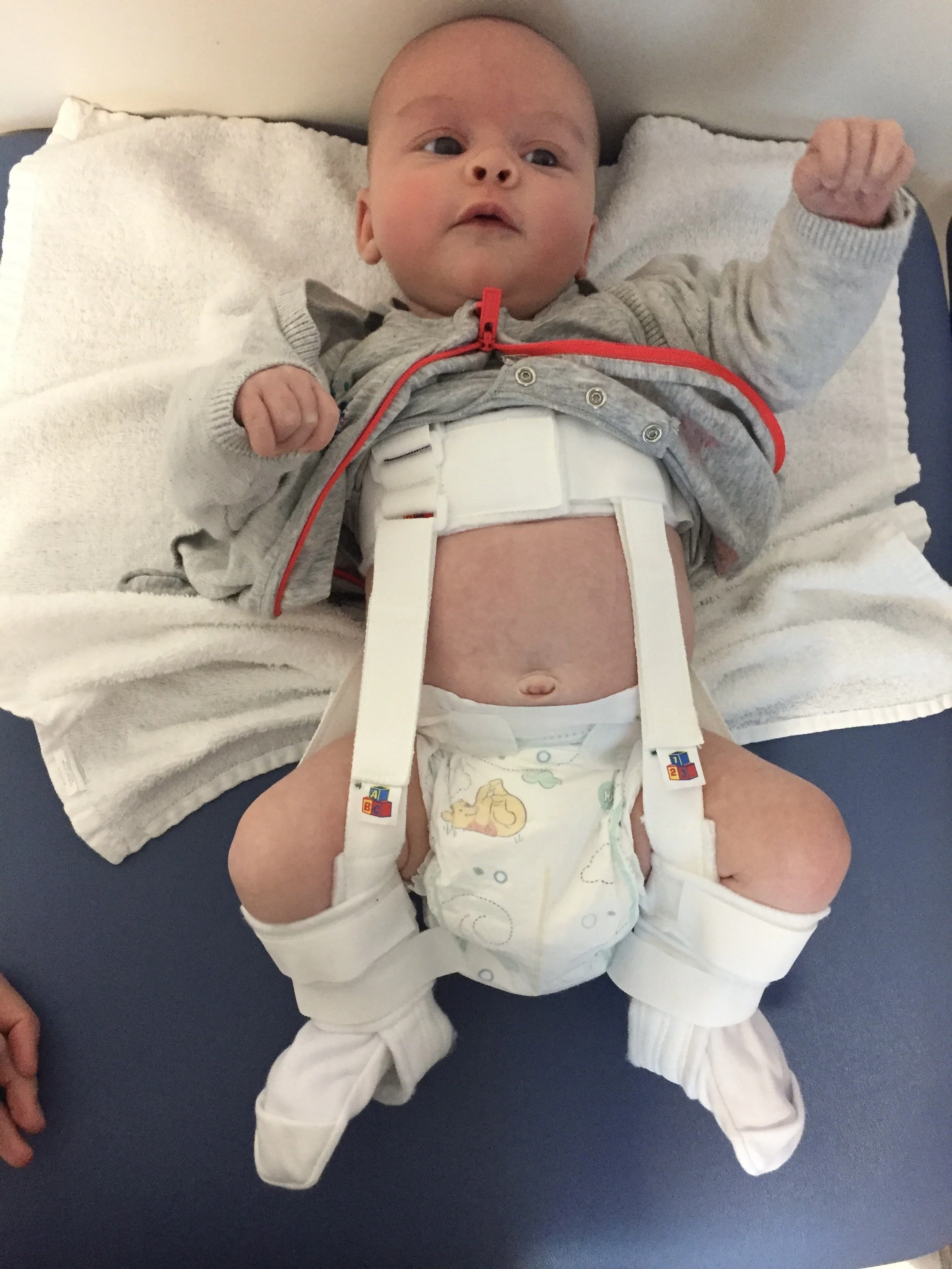 Hip dysplasia.  What is it? Can babies and adults have hip dysplasia?