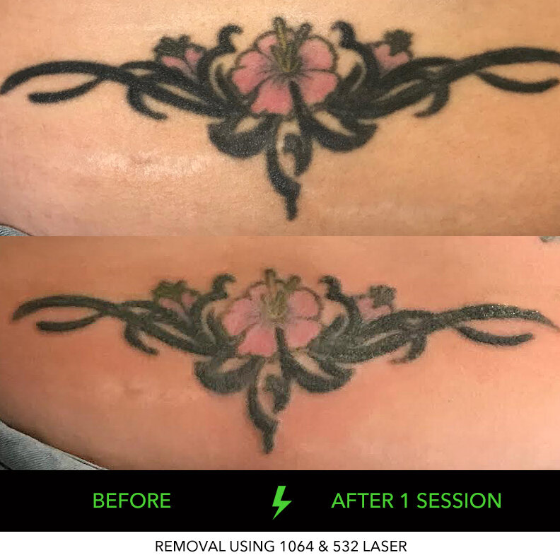 ND-YAG Tattoo Removal Adelaide | Laser & Non Laser Tattoo Removal in  Adelaide