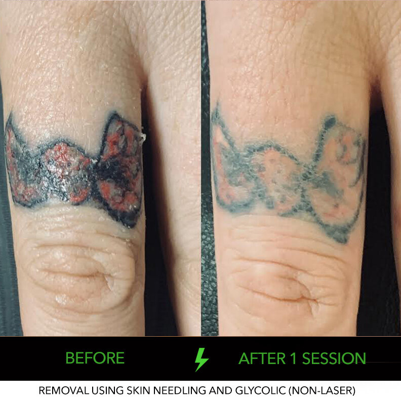Tattoo Removal Gallery Tattoo Removal Gallery