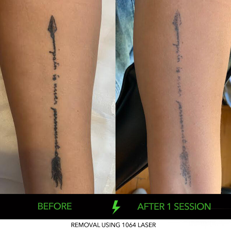ND-YAG Tattoo Removal Adelaide | Laser & Non Laser Tattoo Removal in  Adelaide