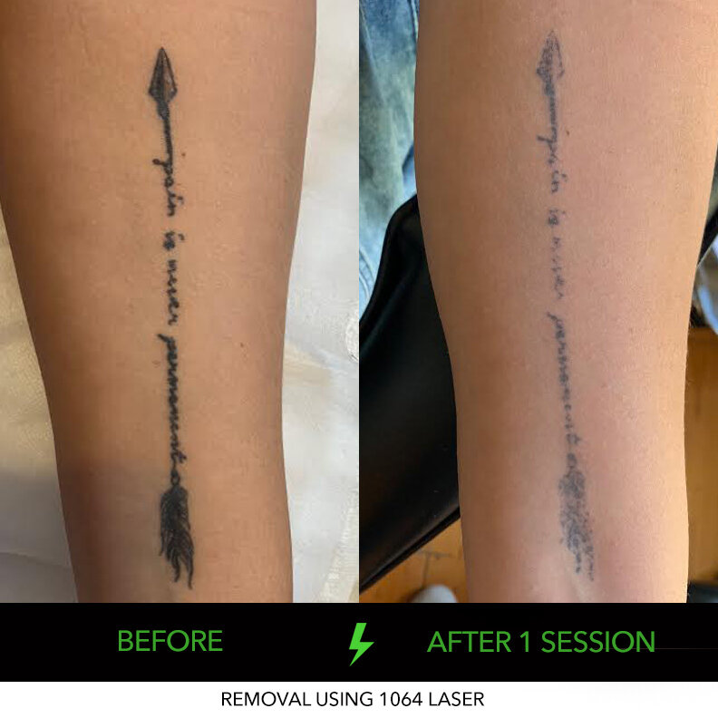 ND-YAG Tattoo Removal Adelaide | Laser & Non Laser Tattoo Removal in Adelaide ND-YAG Tattoo Removal Adelaide | Laser & Non Laser Tattoo Removal in Adelaide
