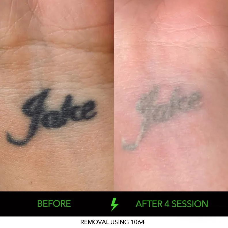 NDYAG Tattoo Removal Adelaide Laser & Non Laser Tattoo Removal in