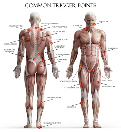 Common+Trigger+Points+Jenna+Baker,+LMT.jpg