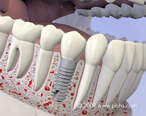 implant.jpg