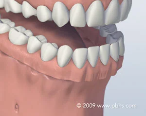 denture.jpg