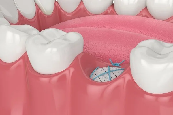 Socket-Preservation-Grafting-2203.jpg