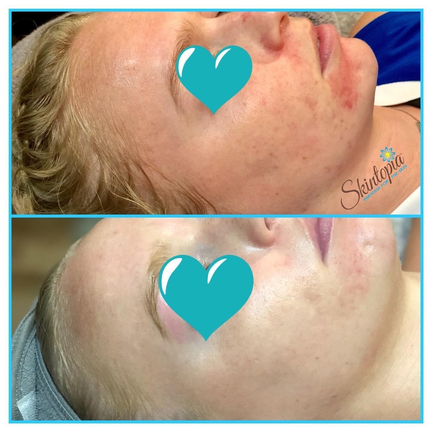 Microneedling before and after results