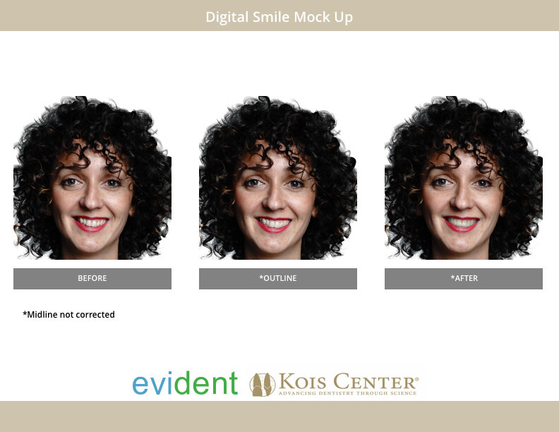 Digital Treatment Simulation Image (Smile Mockup)