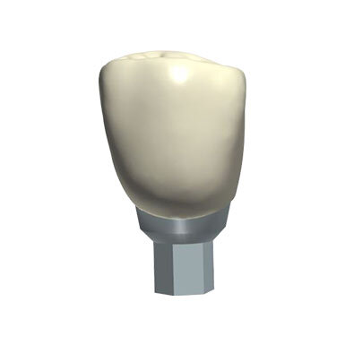 Screw/cement retained crown