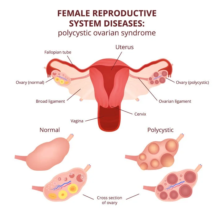 polycystic_ovary_syndrome_PCOS56801820_M.jpg