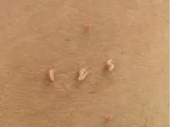 Skintag2.jpg