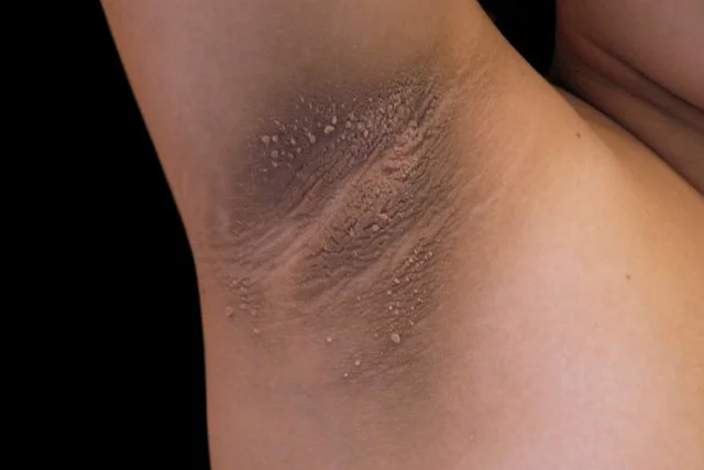 Typical presentation of Acanthosis Nigracans (note the skin tags - same cause)