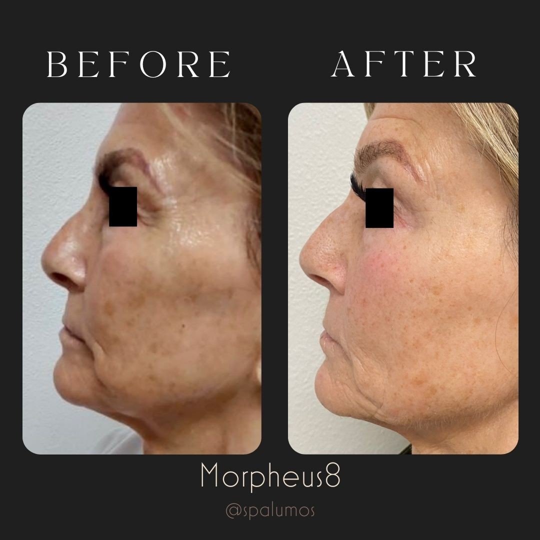 We are absolutely loving these results!😍 ⁠
⁠
So excited for our beautiful client! 🤗⁠
⁠
#Morpheus8 and #Lumecca really are the power couple!⁠
⁠
Book a free consultation today to see if these treatments are right for you. Use our link in Bio to sched