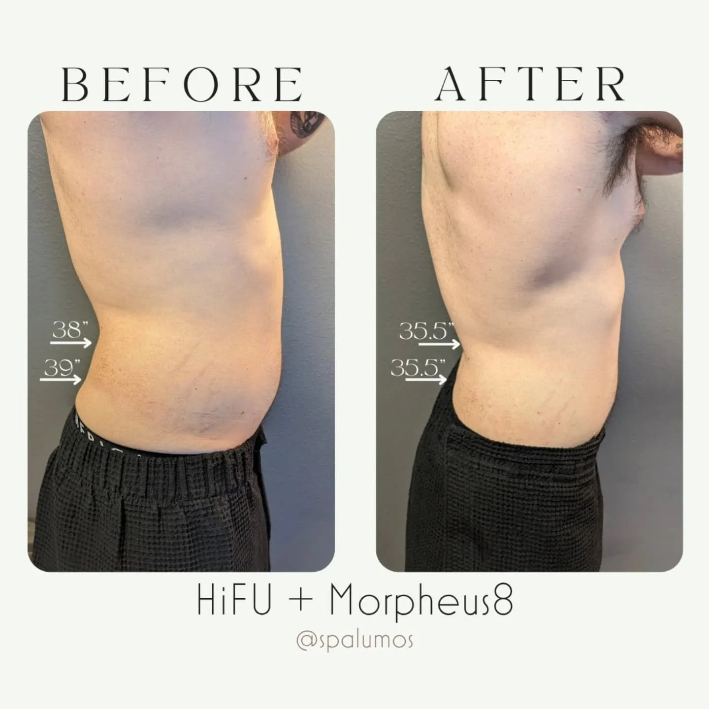 Incredible results! We did a combination of Morpheus8 RF Microneedling and HiFU to help reduce and define his torso. Our treatments coupled with good nutrition and an active lifestyle can make a big difference! 

Want to know more about how we can he