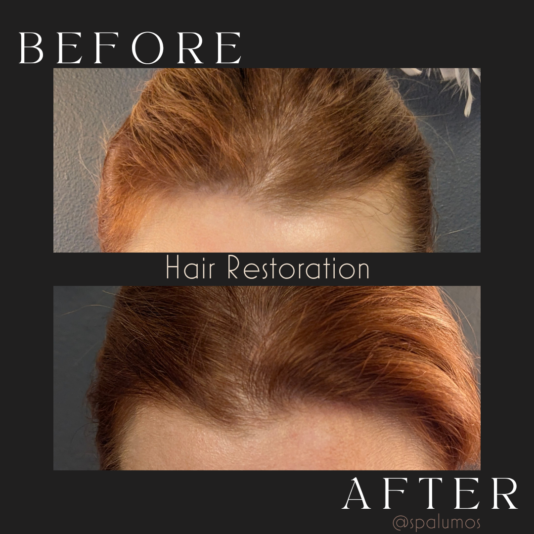 Spa Lumos hair restoration before and after showing fuller-looking hair near the frontal hairline