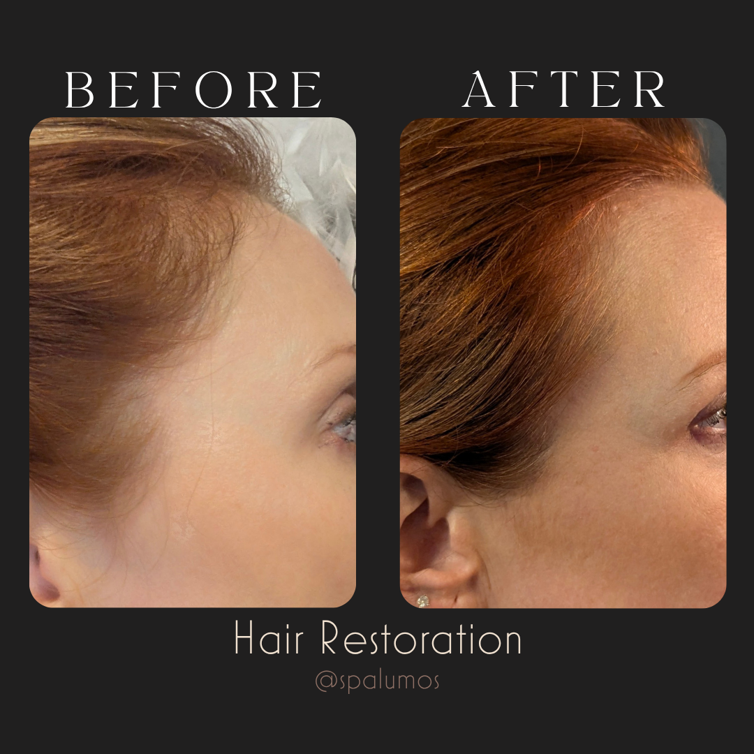 Spa Lumos hair restoration before and after showing improved fullness near the temple and hairline