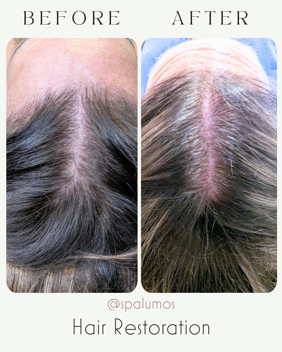 Spa Lumos hair restoration before and after showing fuller-looking hair along the scalp part in Boise, Idaho