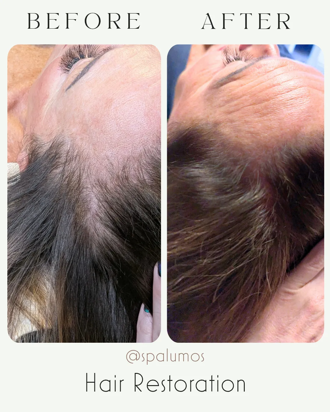 Spa Lumos hair restoration before and after showing improved hair density in Boise, Idaho