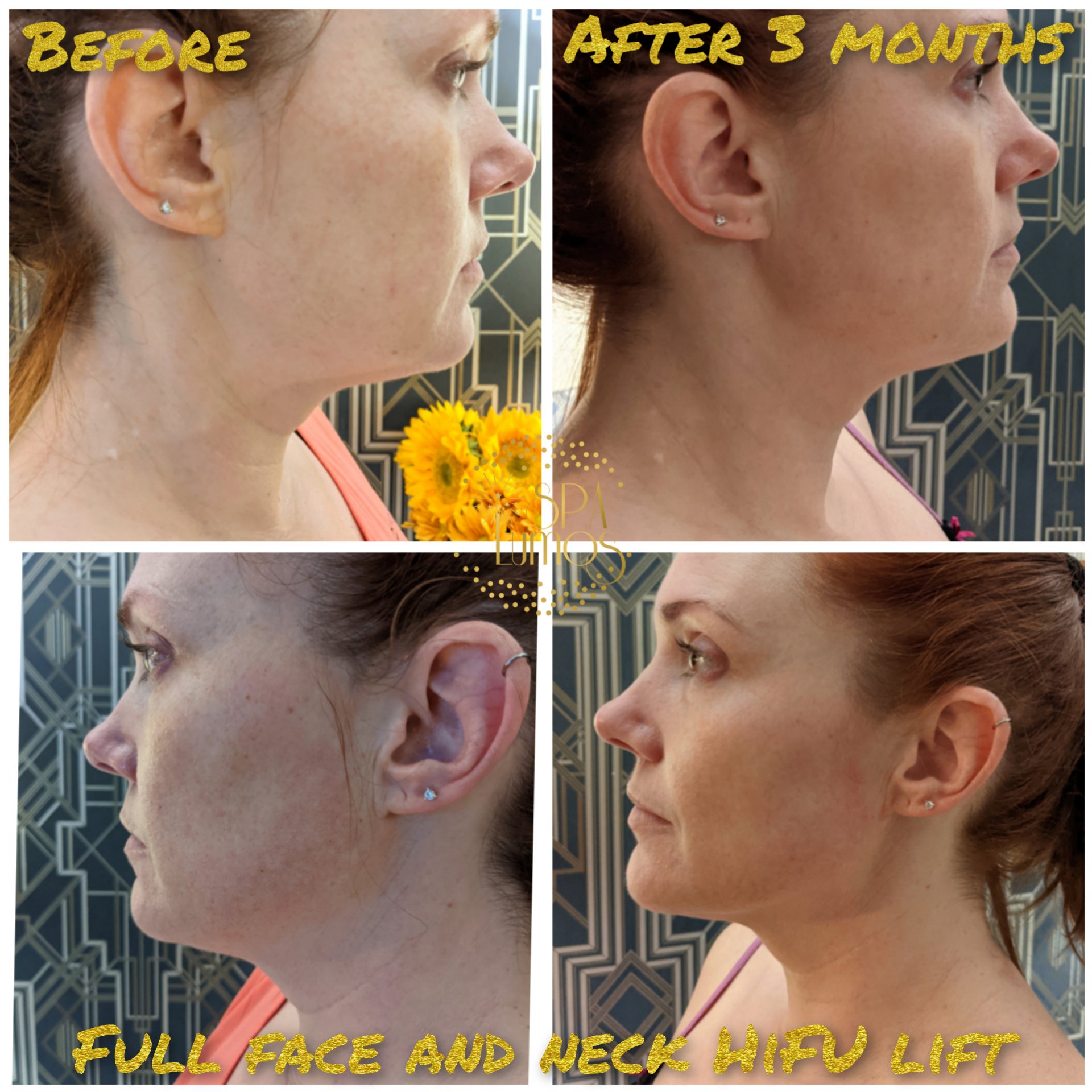 Brooke+D+3mo+HIFU.jpg?format=2500w