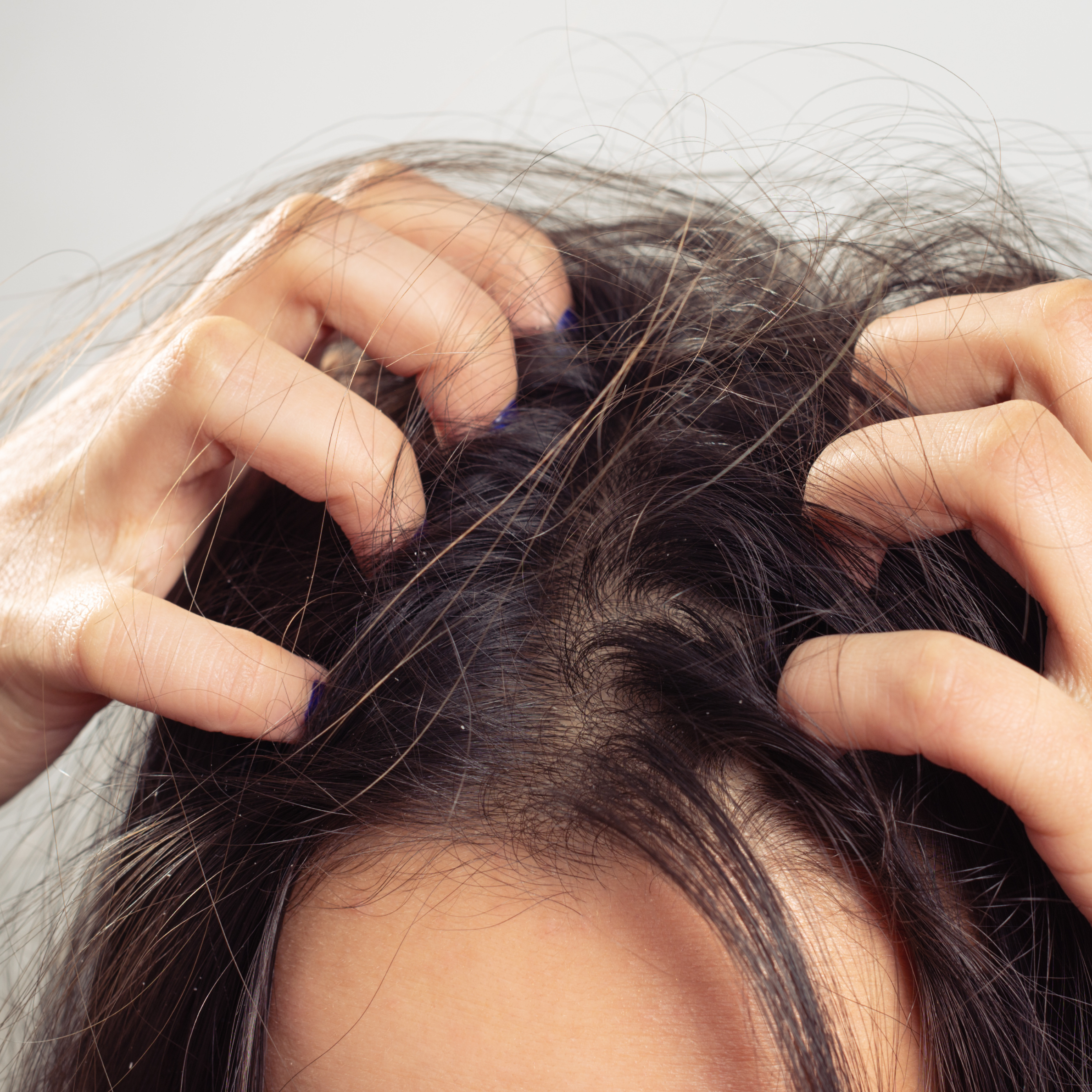 A close-up image of a person's scalp with hands scratching it, showing dark hair and some visible dandruff or dry skin flakes.