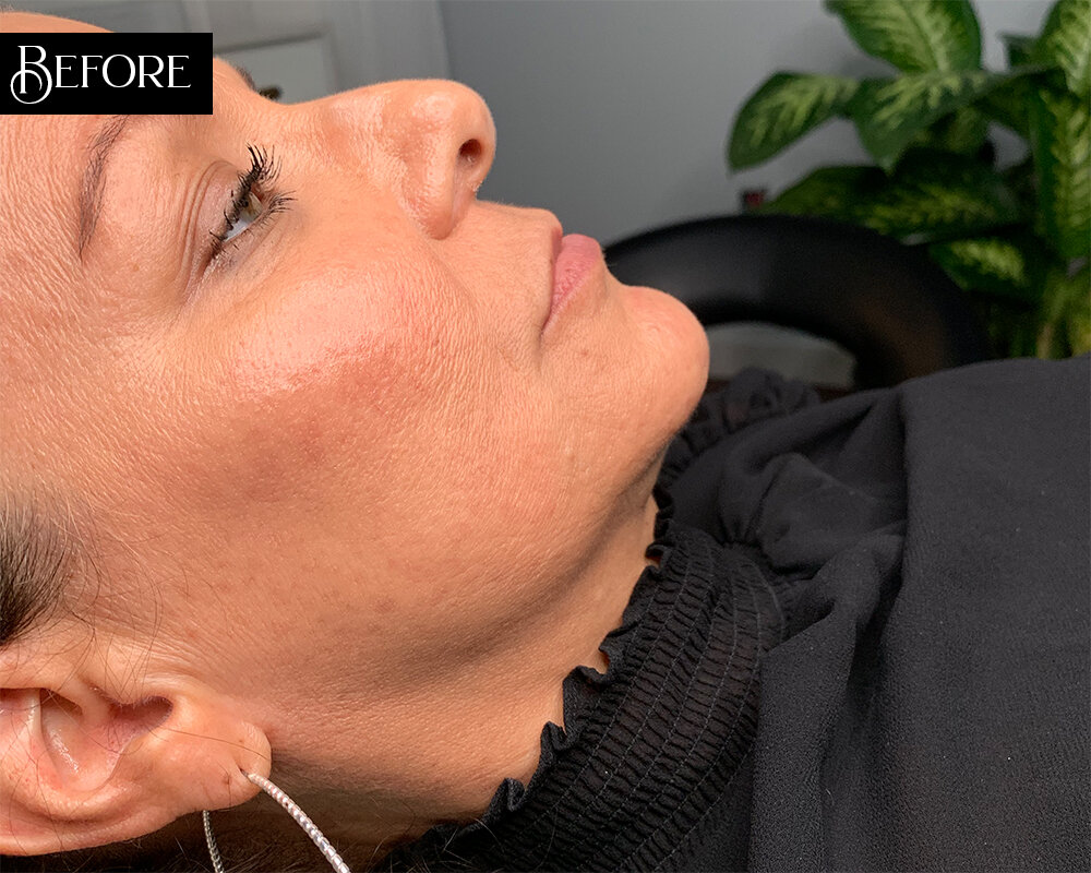 Skin Craft Beauty - Lip Enhancement