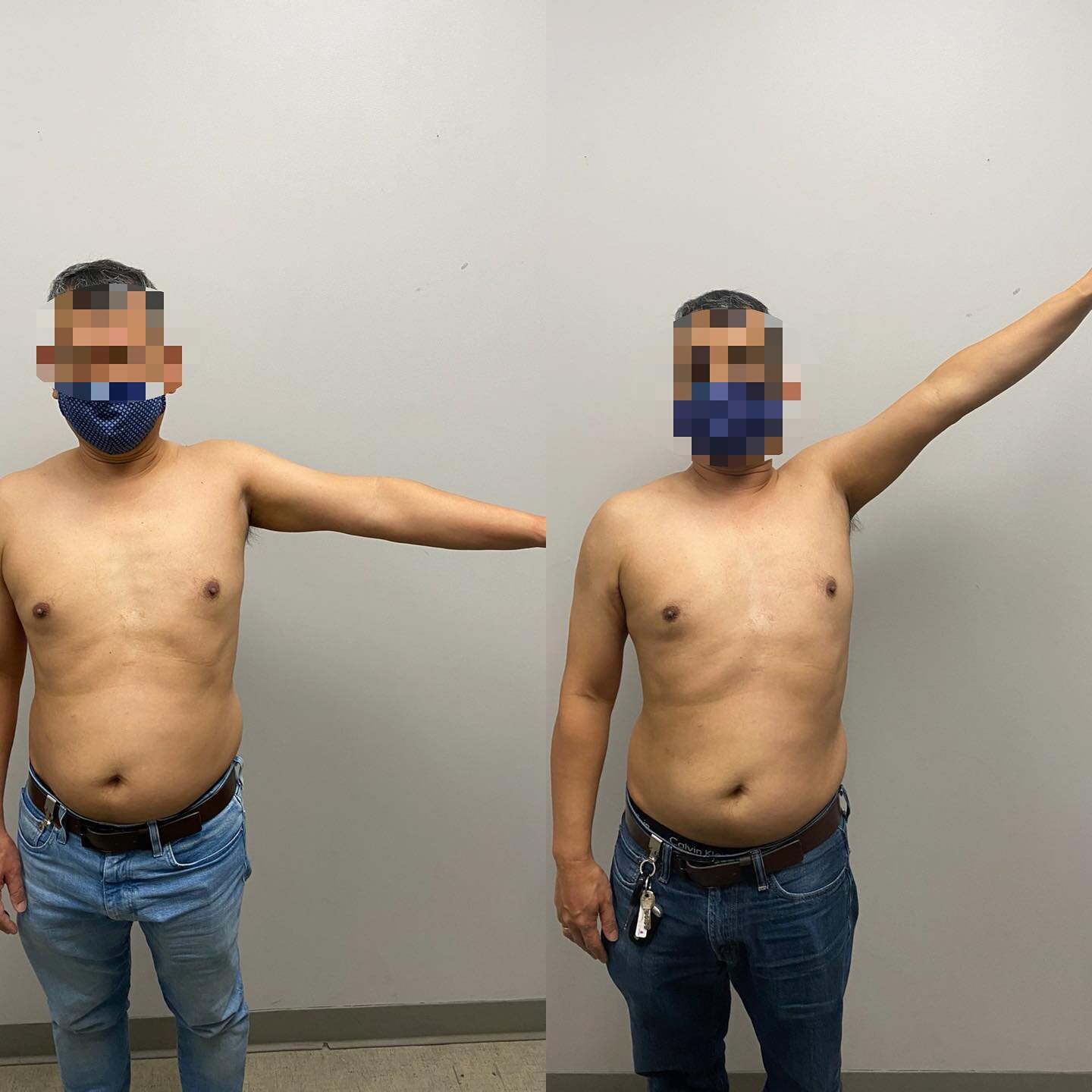 First vs. Third treatment for Frozen Shoulder. Let&rsquo;s just say the patient is super happy with the results since he&rsquo;s been dealing with this for 2 years and has tried injection therapy and other physical therapy. 
.
.
.
#frozenshoulder #fr